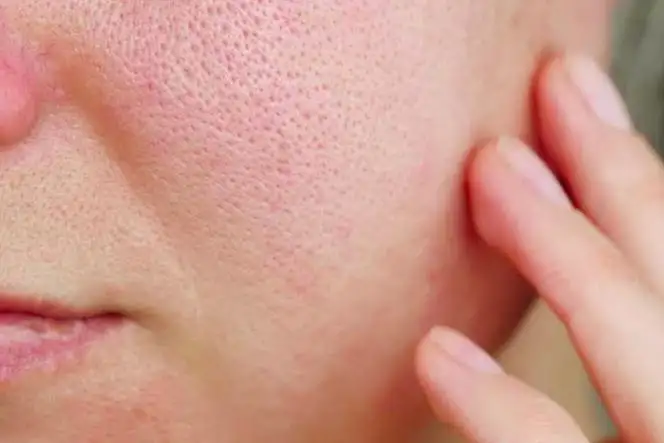 Cara Mengecilkan Pori-Pori Wajah yang Besar