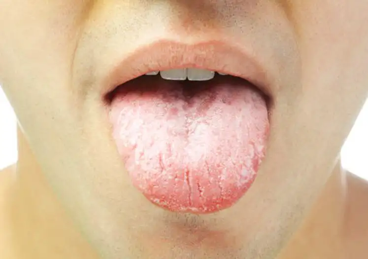 Cara Menghilangkan Rasa Pahit di Mulut Secara Alami dan Medis yang Efektif